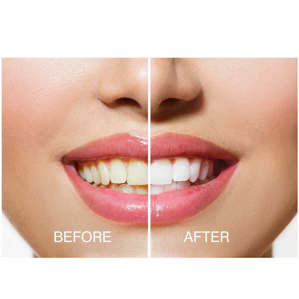 Rio Rio Smile White Advanced Teeth Whitening Kit Convenienza