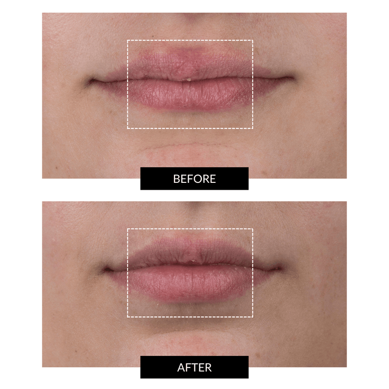 CurrentBody Skin LED Lip Perfector Vendite Flash
