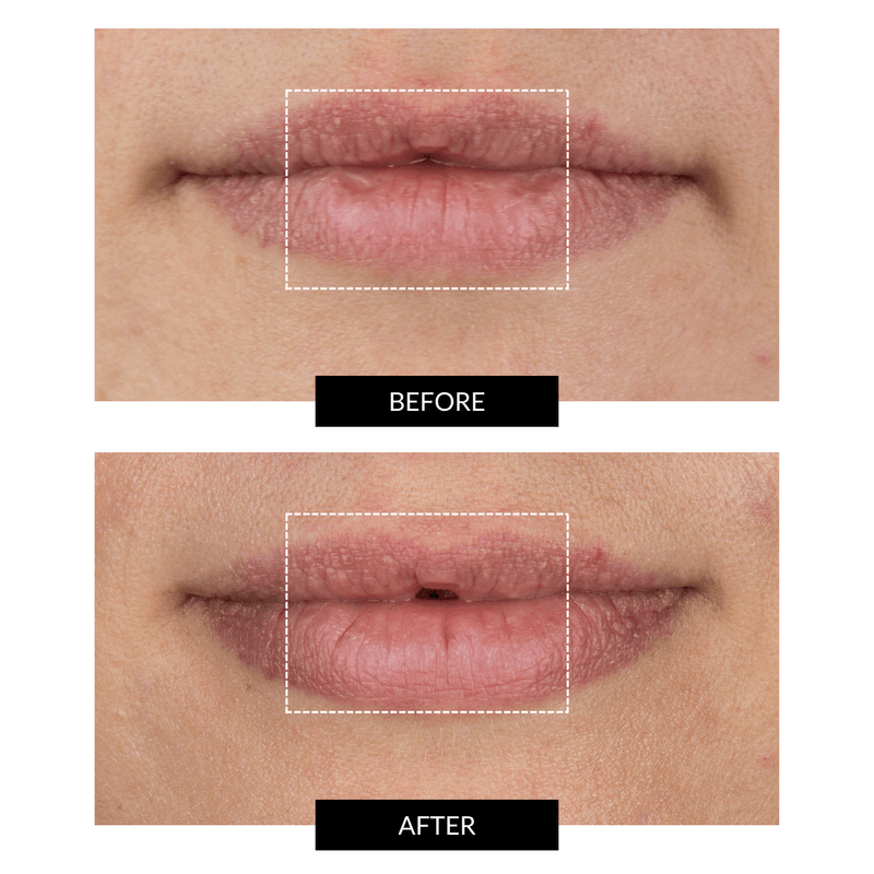 CurrentBody Skin LED Lip Perfector Vendite Flash