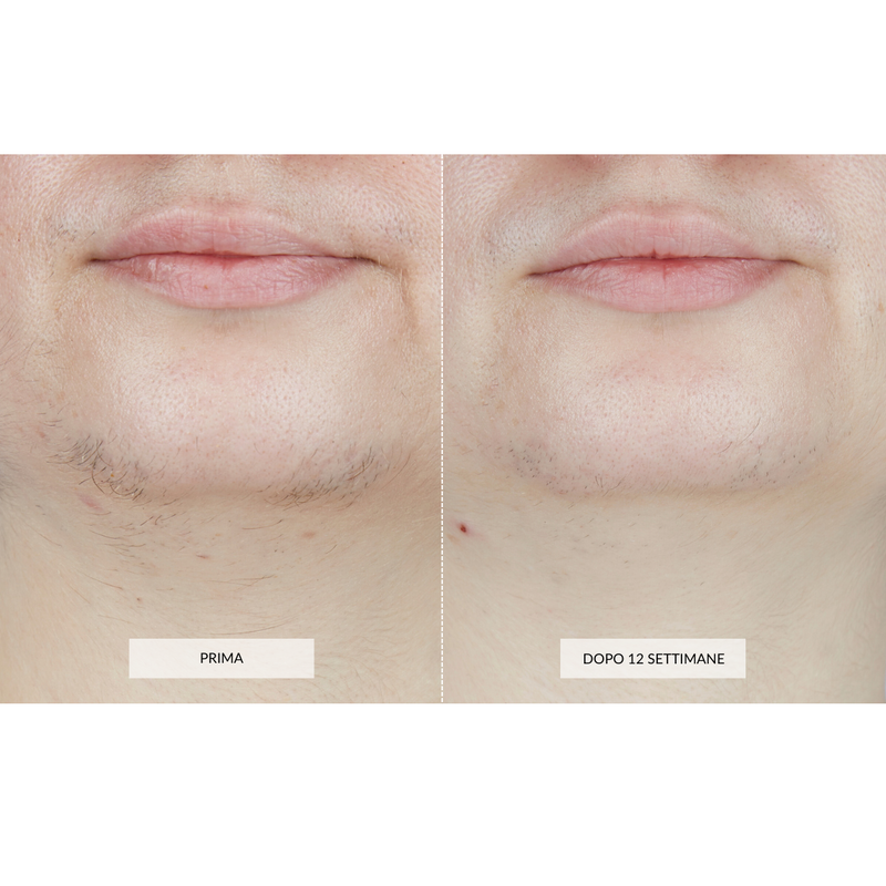 CurrentBody Skin Dispositivo di Epilazione Laser Pezzi Unici