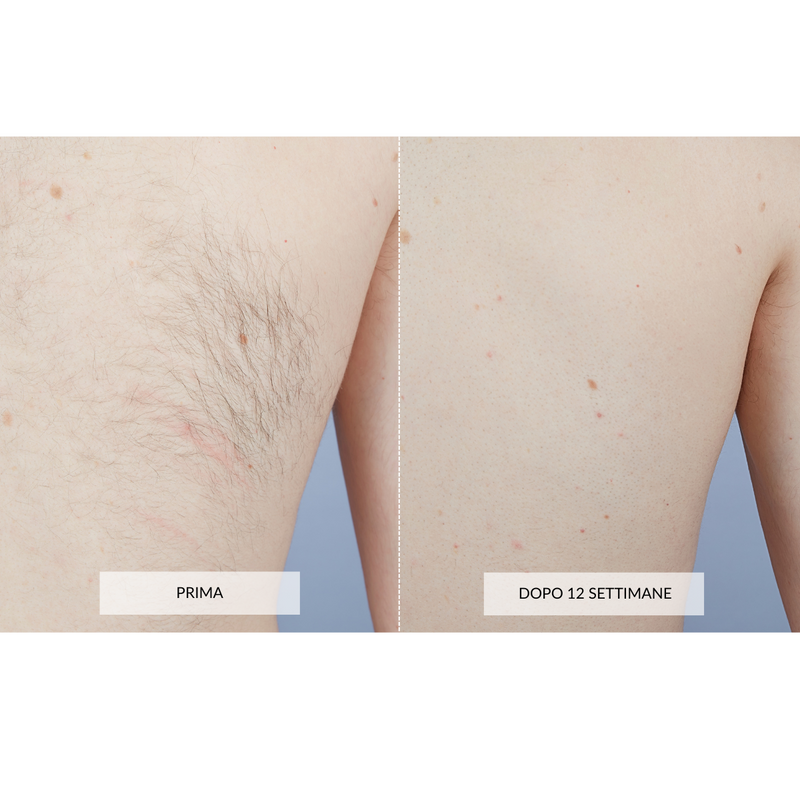 CurrentBody Skin Dispositivo di Epilazione Laser Pezzi Unici