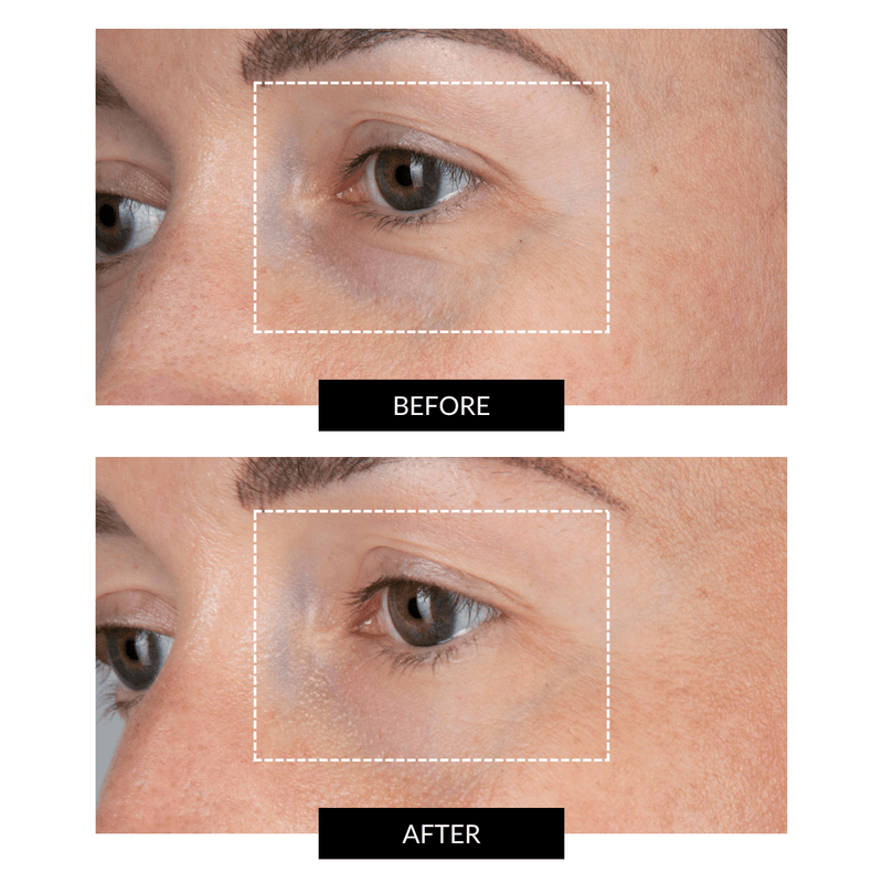 CurrentBody Skin LED Eye Perfector & 5 Eye Hydrogel Masks (del valore di 249€) Presa