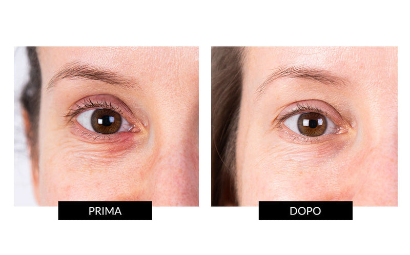 Nira Skin Nira Precision Laser In Linea