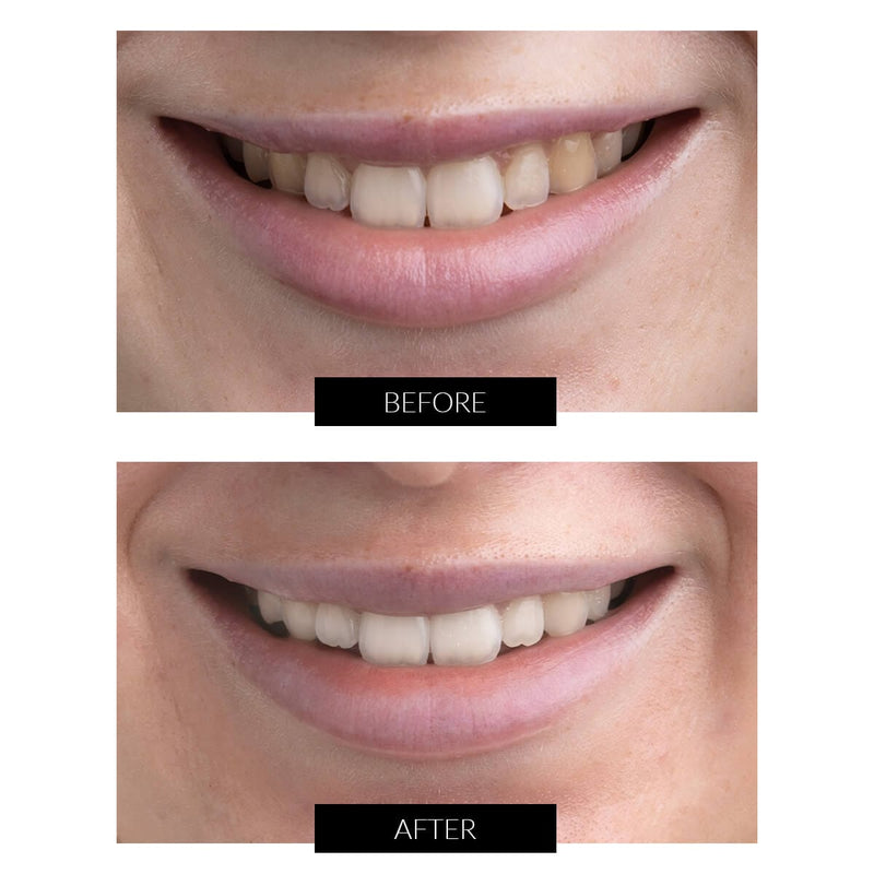 CurrentBody Skin Offers CurrentBody Skin Kit Sbiancamento Denti LED Offerta Fino Al -60%